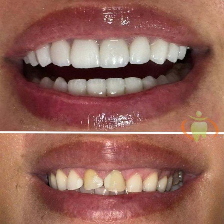 Paciente recibiendo tratamiento de diseño de sonrisa.